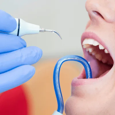 Caries en CDMX: origen, evolución y complicaciones dentales