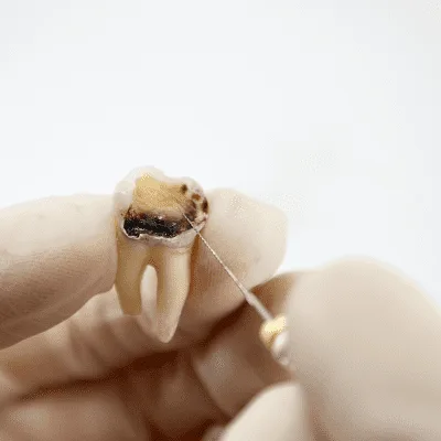 Dientes apiñados en CDMX: causas, consecuencias y salud bucal