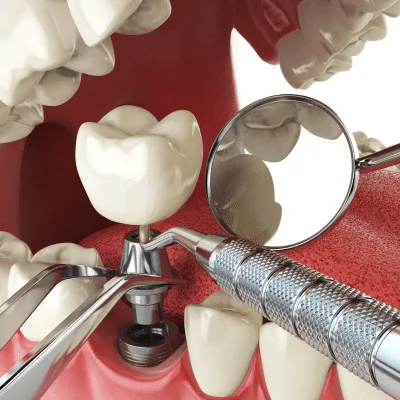 Diagnóstico y tratamiento avanzado de la gingivitis en CDMX
